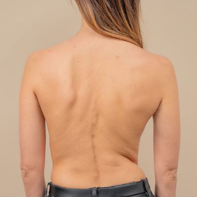 Scoliosis